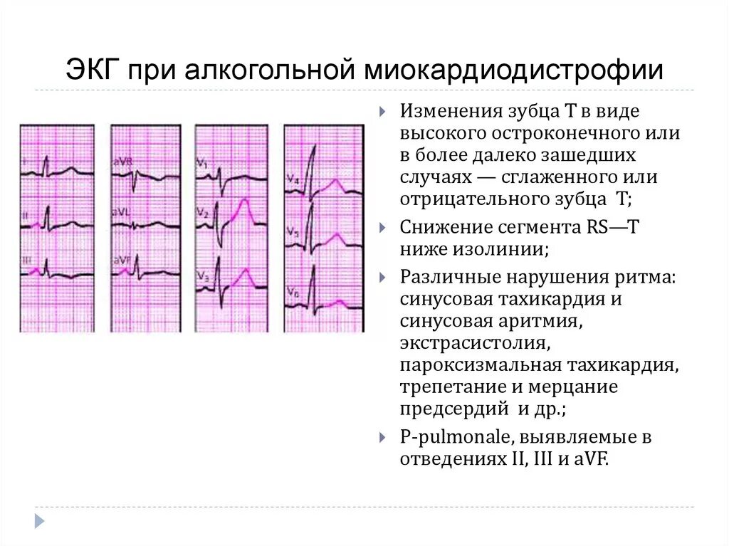 ЭКГ при алкогольной миокардиодистрофии. ЭКГ при алкогольной кардиомиопатии. Дистрофия миокарда на ЭКГ. ЭКГ при дистрофии миокарда. Экг метаболические изменения что это значит