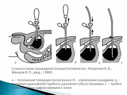 Удаление мочевого пузыря сколько длится операция