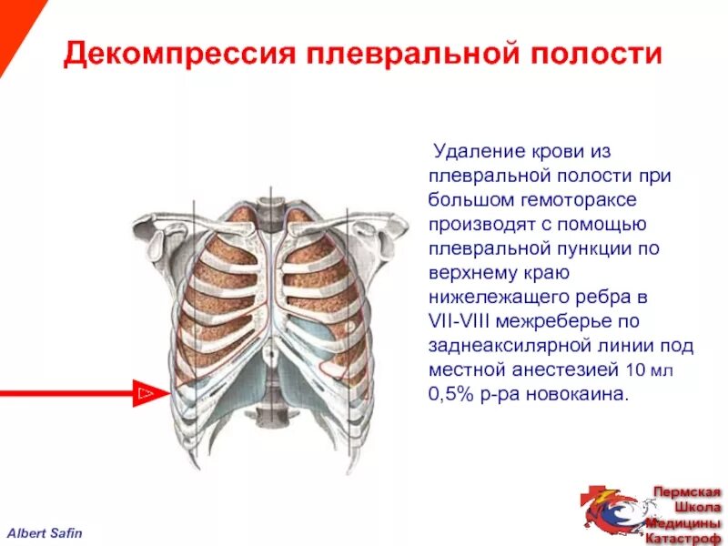 Пункция плевральной полости по верхнему краю ребра. Гемоторакс пункция плевральной полости. Плевральная пункция при гемотораксе. Места пункции плевральной полости. Наличие крови в плевральной полости