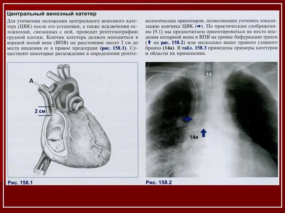 Образование левого предсердия. Подключичный катетер рентген контроль. Центральный венозный катетер рентген. Верхняя полая Вена Рент.