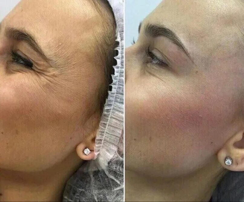 Шишки после уколов ботокса