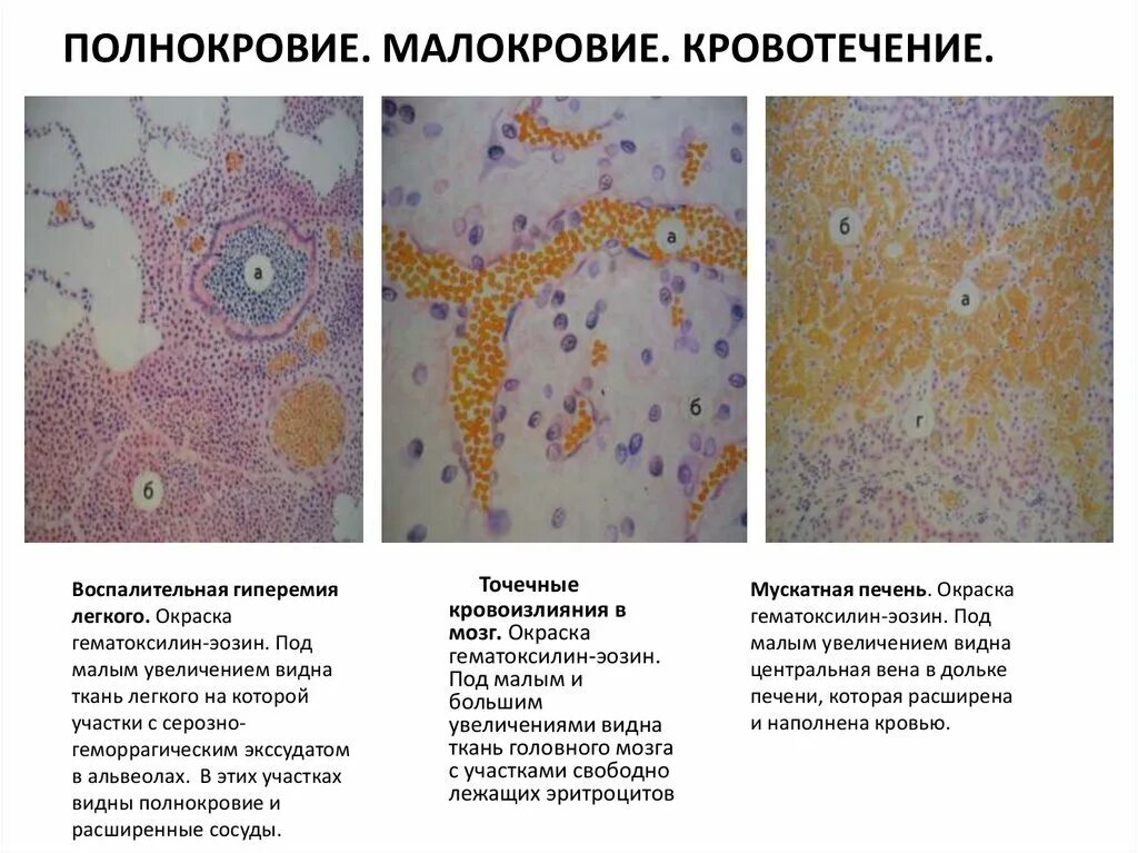 Венозное полнокровие печени микропрепарат. Венозное полнокровие патанатомия. Венозное полнокровие печени гистология. Мускатная печень микропрепарат патанатомия. Печень микропрепарат описание