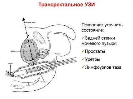 Что такое биопсия предстательной железы