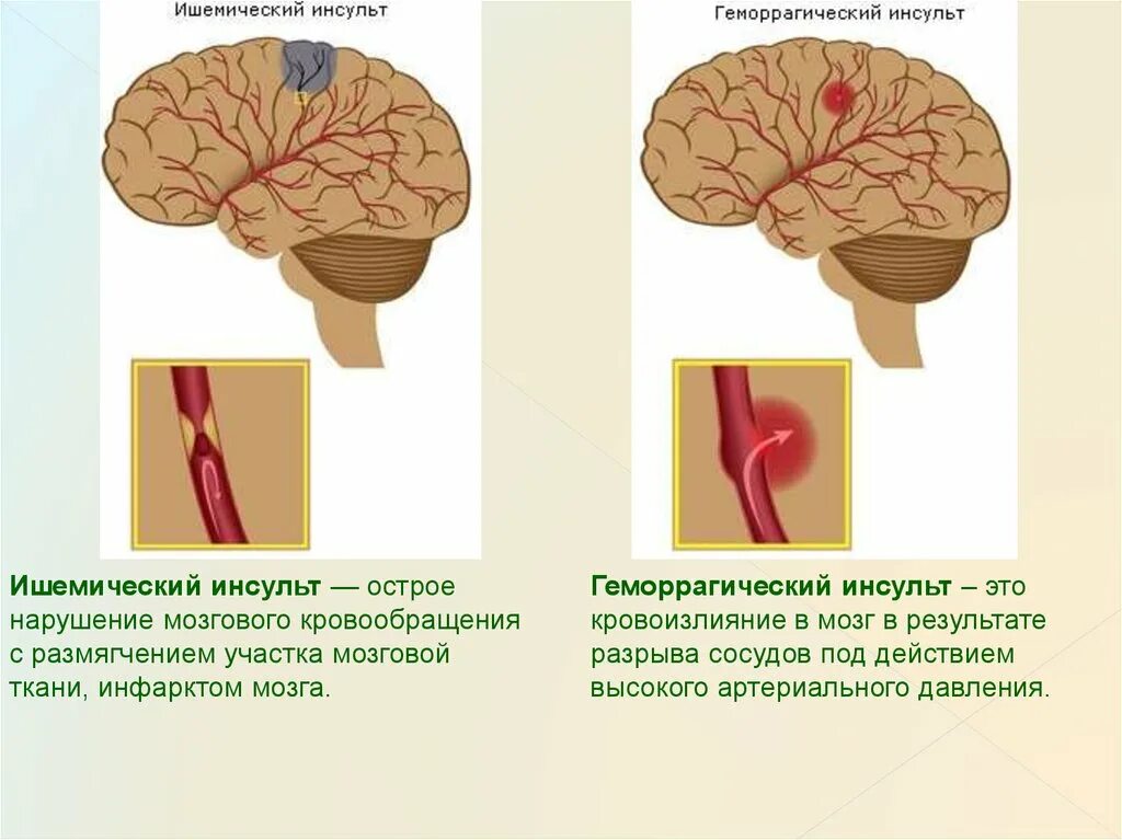 Инсульт лечение прогноз. Ишемический инсульт схема. Геморрагический и ишемический инсульты схема. Типы ишемического инсульта. Инсульт и ишемический инсульт.