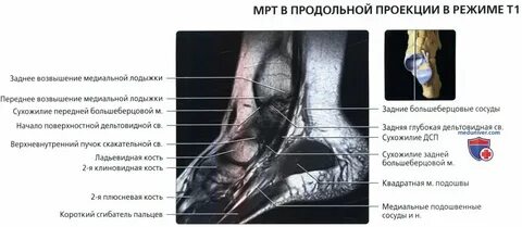 Связки голеностопного сустава мрт