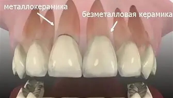 Чем отличается металлокерамика