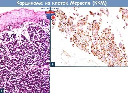 Фокус карциномы