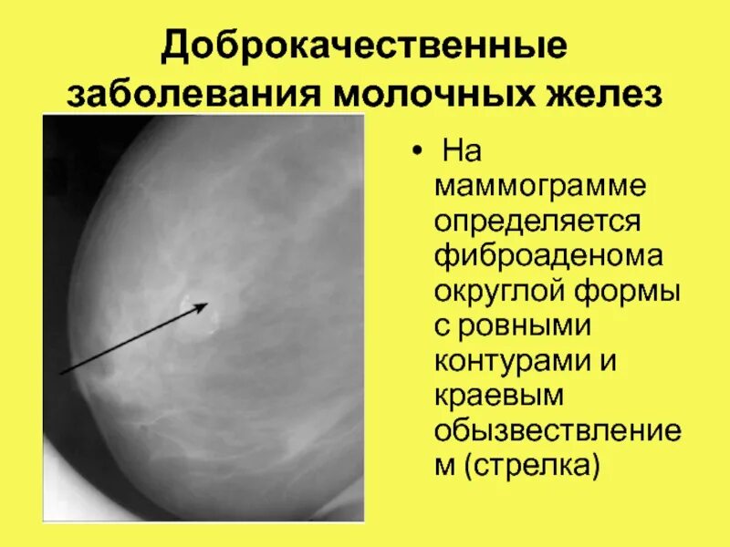 Образование молочной. Фиброаденома молочной железы маммография. Доброкачественные заболевания молочной железы. Доброкачественная опухоль молочной железы. Доброкачественные новообразования молочных желез.