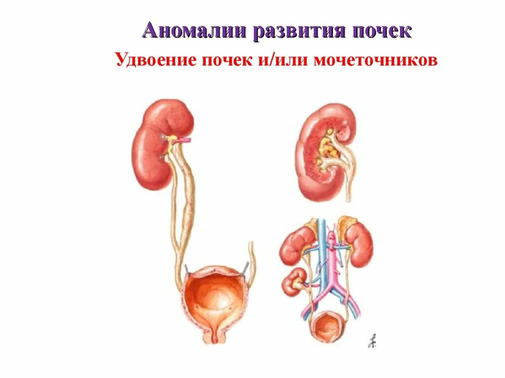 Аномалии развития мочеполовой. Аномалии мочевыводящей системы почки. Пороки развития почек и мочевых путей. Аномалии развития мочевыводящей системы. Пороки развития мочеточника.