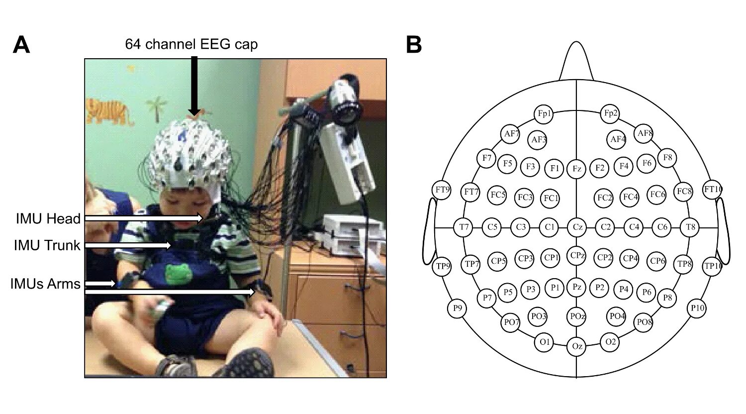 Луки ээг. Расположение электродов ЭЭГ. ЭЭГ мониторинг головного мозга. ЭЭГ шапочка схема. Электроэнцефалография головного мозга (ЭЭГ).