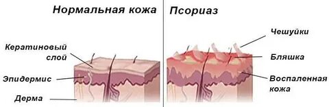 Псориатическая триада это