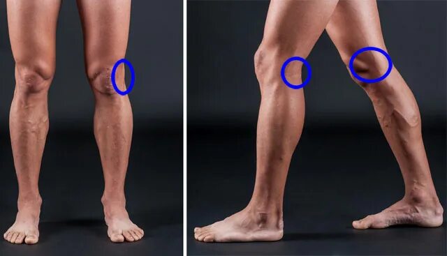 Болит под коленом что это может быть. Наружная сторона колена. Внутренняя сторона Коле. Внутренняя сторона колена.