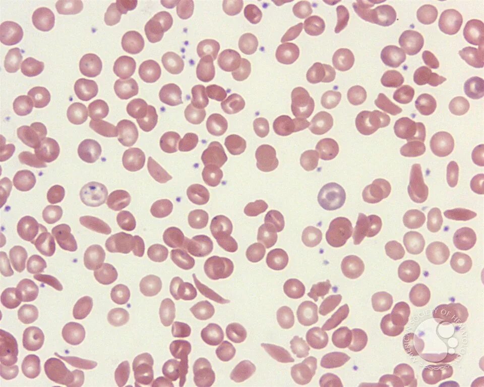 Ген серповидноклеточной анемии. Серповидноклеточная анемия картина крови. Серповидноклеточная анемия гистология. Железодефицитная анемия гистология. Серповидноклеточная анемия мазок крови.