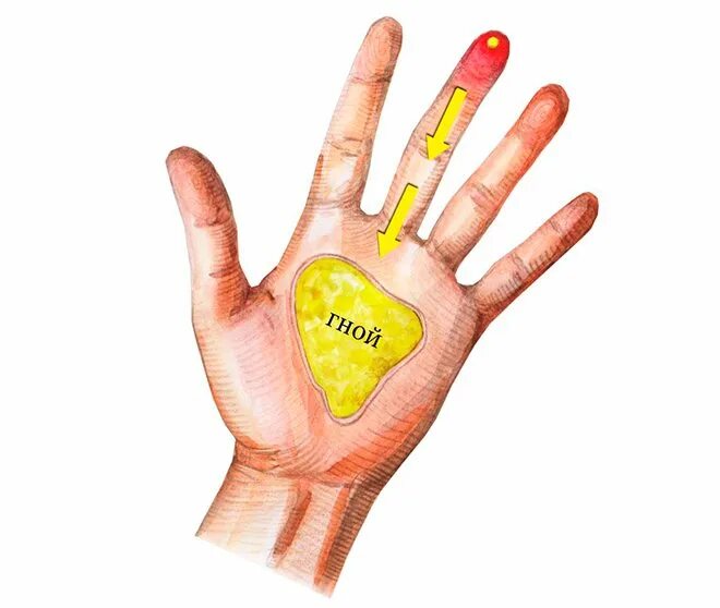 мудра огня сурья. болят средний и безымянный пальцы. онемение мизинца и безымянного пальцев. подушечка большого пальца на руке. подушечка указательного пальца.