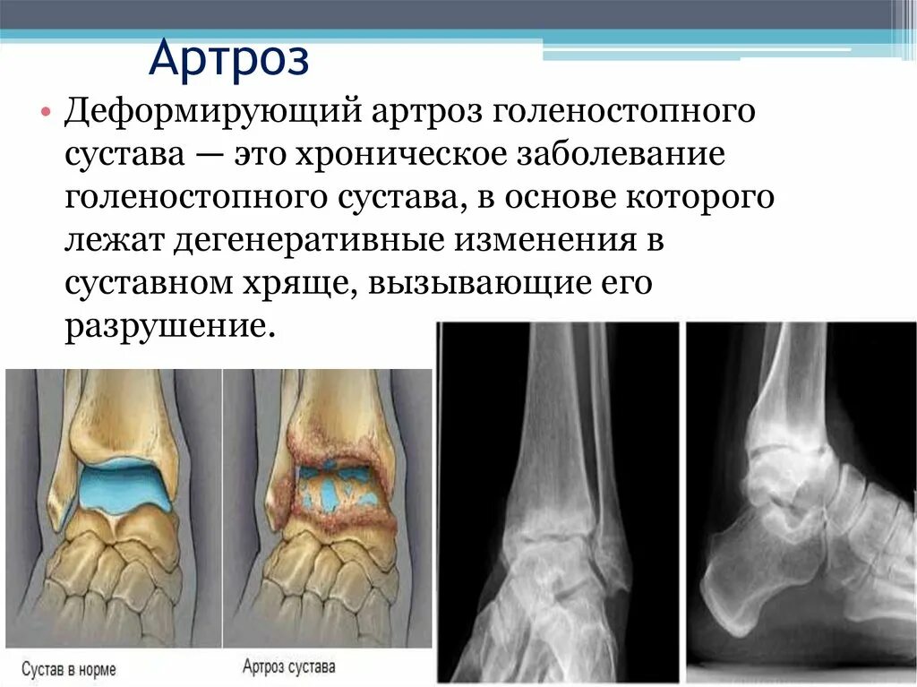 Диагноз доа суставов. Деформирующий артроз голеностопного сустава рентген. Артроз голеностопного сустава 2 степени рентген. Деформирующий артрит голеностопного сустава. Артроз голеностопного сустава рентген 1 стадии.