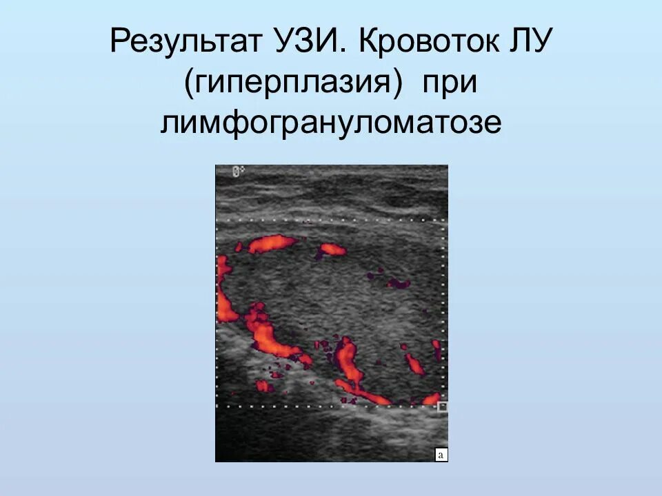 Перинодулярный кровоток что это. Перинодулярный Тип кровотока. Перинодулярный кровоток УЗИ. Обводной кровоток по УЗИ. В режиме ЦДК кровоток перинодулярный.