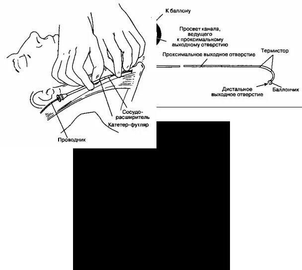 дистальный конец катетера фолея. дистальный конец катетера фолея. классификация катетеров уретральных. дистальный кончик катетера. проксимальный конец катетера это.