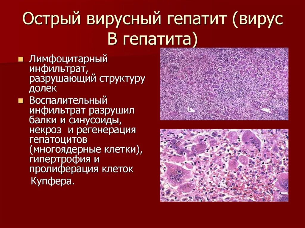 Вирусный гепатит печени. Вирусный гепатит б патанатомия. Вирусный гепатит макропрепарат патанатомия. Вирусный гепатит в патологическая анатомия макропрепарат. Вирусный гепатит в патологическая анатомия микропрепарат.