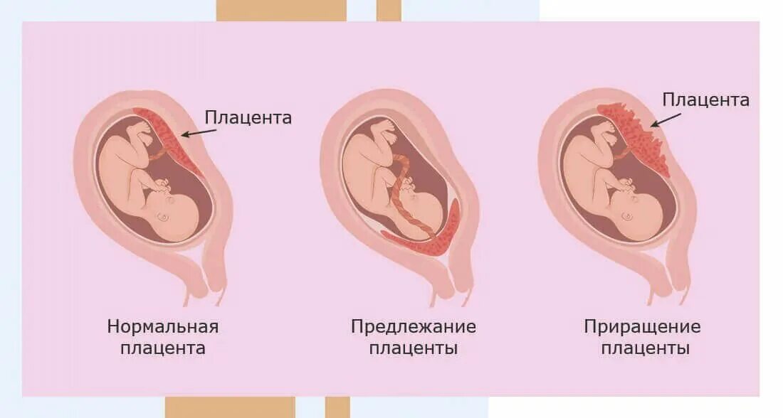 Беременность после общего. Названия плода у беременных. Процесс зародыша ребёнка. Таблетки для плаценты при беременности.