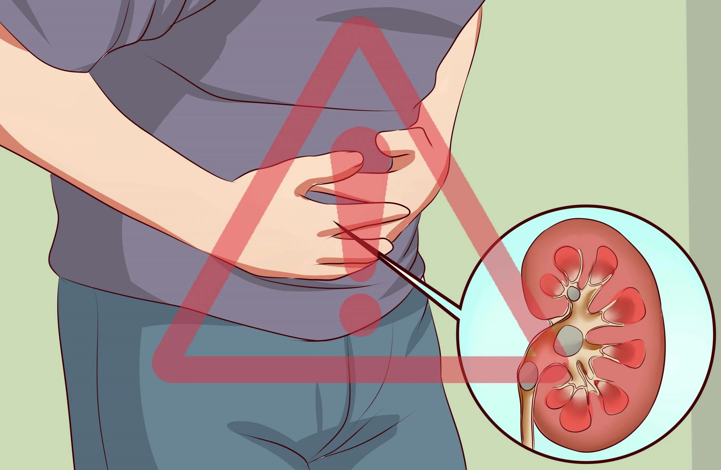 Мочевая колика. Мочекаменная болезнь мочеиспускание. Нефролитиаз почек что это такое симптомы. Камни в посках симптом.
