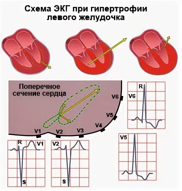 Нарушение процесса реполяризации желудочков в нижней стенке. Ранняя реполяризация желудочков на ЭКГ. Гипертрофия миокарда левого желудочка сердца на ЭКГ. Нарушение процессов реполяризации левого желудочка. Нарушение реполяризации желудочков на ЭКГ.