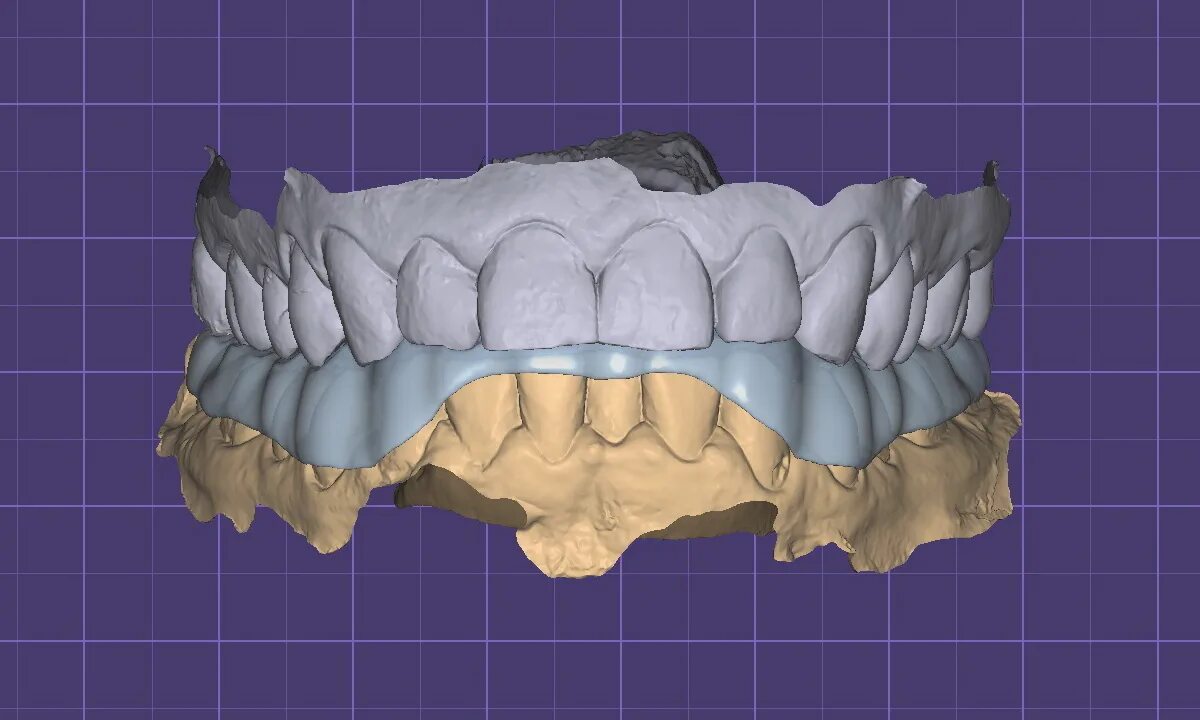 окклюзионная шина сплинт. окклюзионная каппа сплит. окклюзионная каппа сплит. капа окклюзионная сплинт. височно-нижнечелюстная дисфункция.