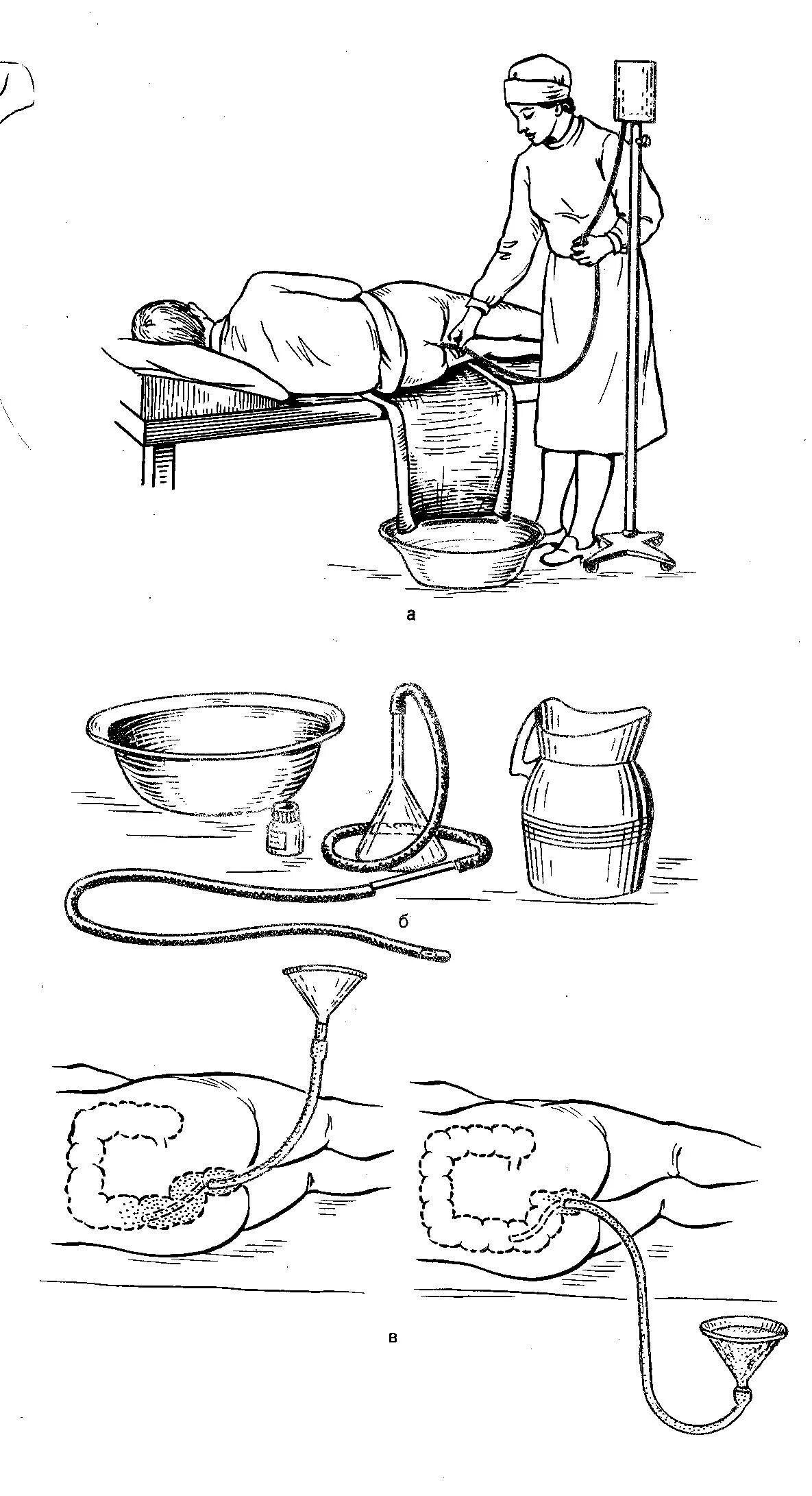 Постановка сифонной клизмы алгоритм. Сифонная клизма алгоритм. Постановка сифонной клизмы. Сифозная клизма алгоритм.