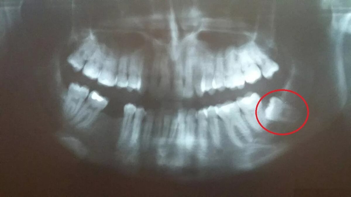 Ретинированный зуб мудрости рентген. Кривой зуб мудрости рентген. Горизонтально ретинированный зуб мудрости. Зуб 8 корень