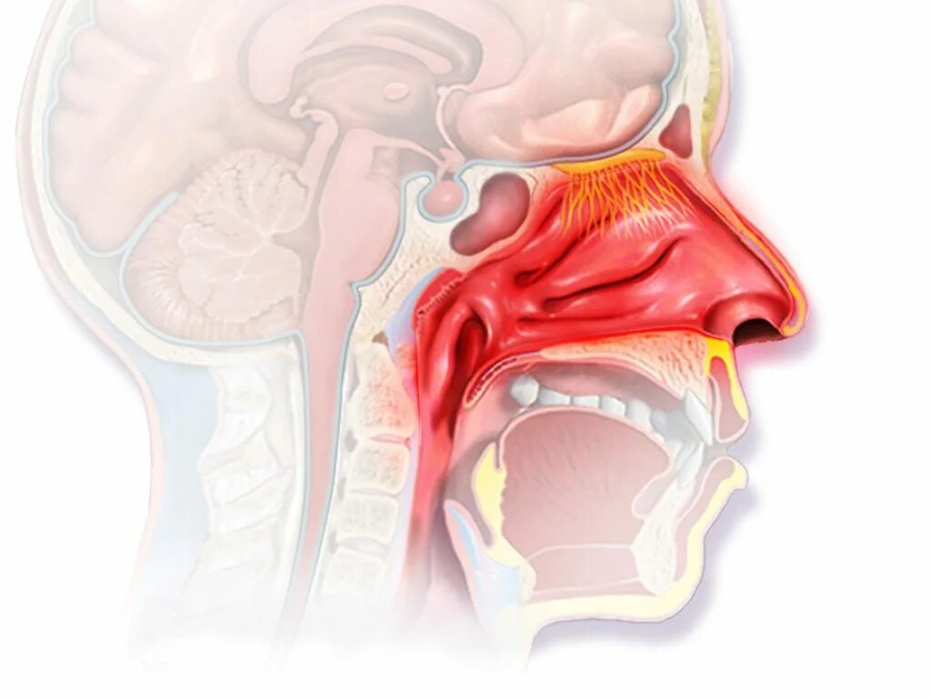 Нос заболевание насморк. Анатомия ЛОР органов аденоиды. Аллергический ринит анатомия. Острый инфекционный ринит.