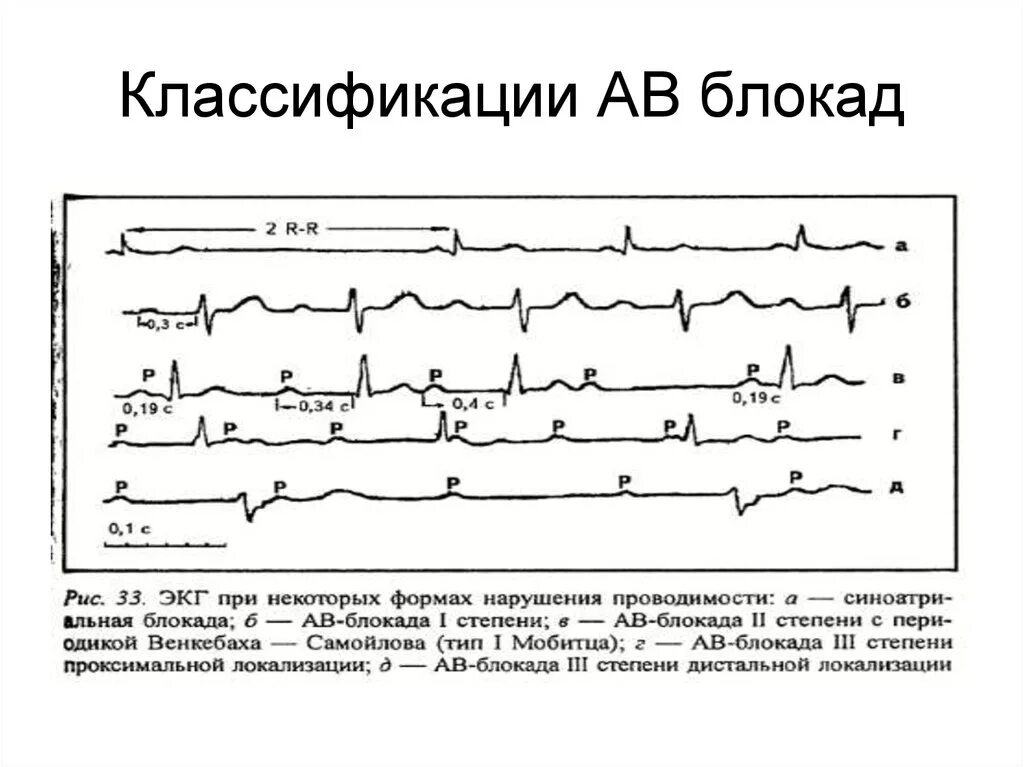 А в блокады это что. Дифференциальная диагностика при ав блокада 2 степени. Ав блокада 2 степени классификация. Клинические проявления блокад сердца. Ав блокада 3 степени на экг.