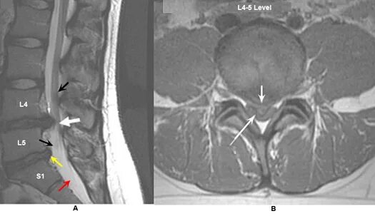 Кт межпозвонкового диска l5—s1. Грыжа л5с1 мрт. Дорзальная грыжа мрт. Секвестрированная грыжа l5-s1 мрт. Сагиттальный размер канала норма