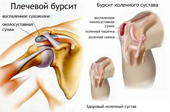 Эффективное лечение плечевого сустава. Бурсит плечевого коленного сустава. Подлопаточный бурсит плечевого. Подакромиальный бурсит плечевого. Бурсит сустава плечевого сустава.