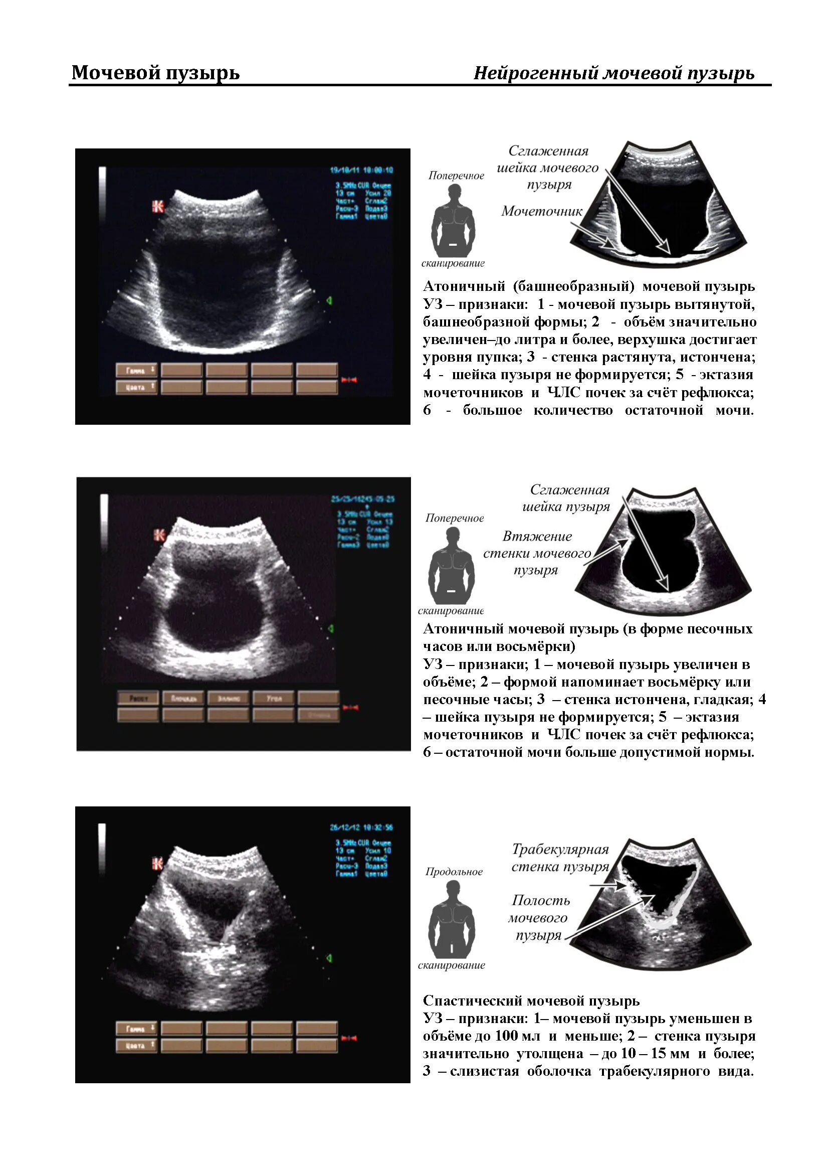 Размер мочевого пузыря у мужчин. Измерение объема мочевого пузыря на УЗИ. Объем мочевого пузыря на УЗИ норма. Расчет объема мочевого пузыря по УЗИ формула. Формула объема мочевого пузыря на УЗИ.