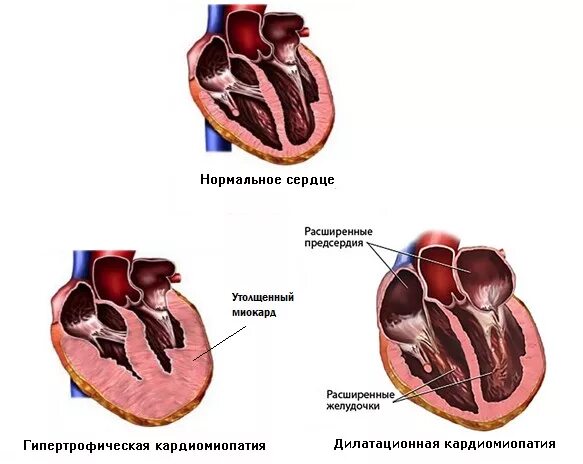 Предсердие желудка. Гипертрофическая кардиомиопатия у собак. Дилатационная кардиомиопатия собак. Дилатационная кардиомиопатия и гипертрофическая кардиомиопатия. Концентрическая кардиомиопатия.