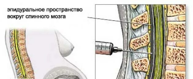 Эпидуральное пространство спинного мозга. Спина после эпидуральной анестезии. Болит спина после эпидуралки. Болит спина после эпидуральной анестезии.