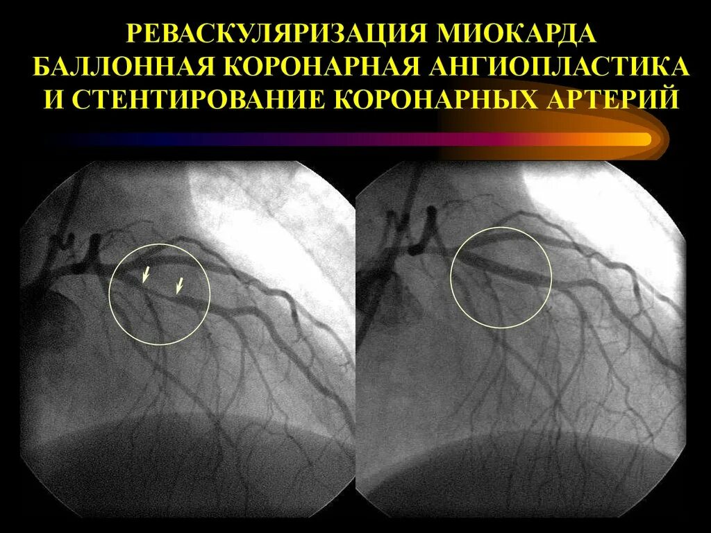 Инфаркт коронарное стентирование. Баллонная ангиопластика и стентирование. Реваскуляризация миокарда. Баллонная ангиопластика коронарных артерий. Стент для коронарных артерий.