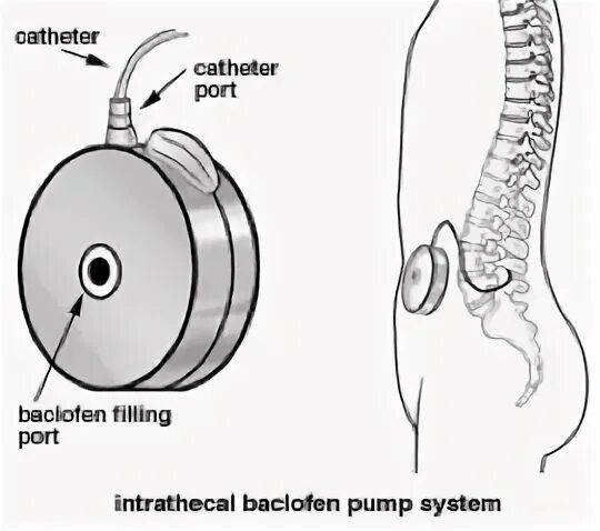 Баклофеновых помп. Баклофеновая помпа. Интратекальный насос. Баклофеновая помпа у детей. Intrathecal Pumps.