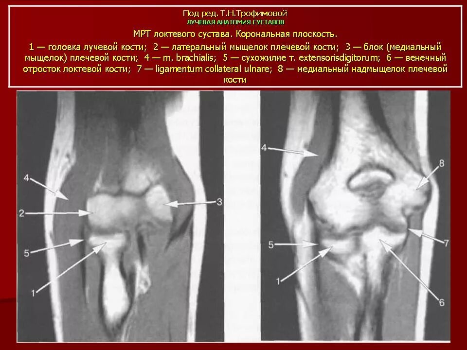 Лигаментоз локтевого сустава. Эпикондилита локтевого сустава мрт. Локтевого мыщелка