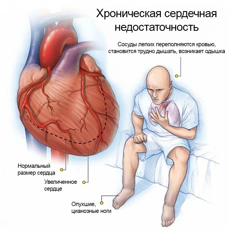 При сердечной недостаточности наблюдается. Хроническая сердечная недостаточность проявления. Хроническая застойная сердечная недостаточность симптомы. Проявления хронической сердечной недостаточности. Хронич сердечная недостаточность симптомы.