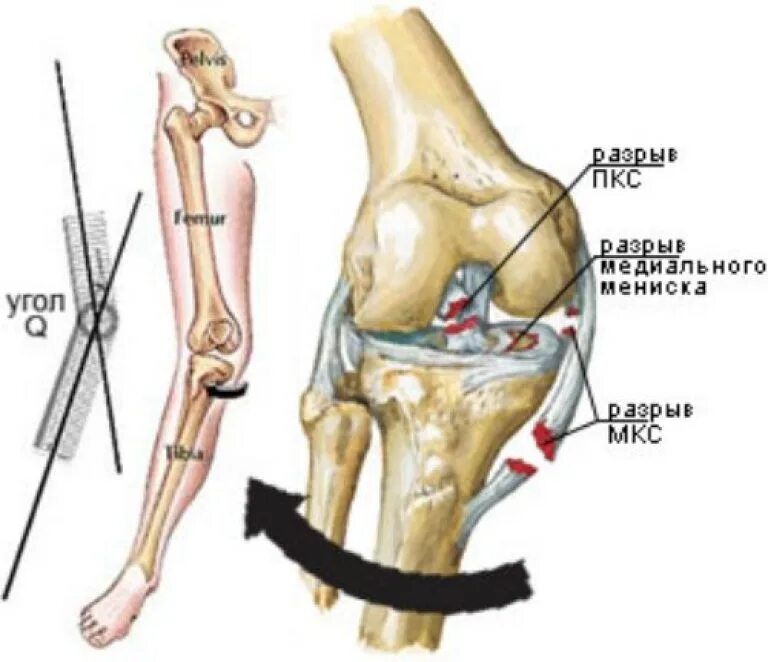 Разрыв назад. Разрыв передней крестовой связки коленного сустава. Травмы боковых связок коленного сустава. Механизм травмы при разрыве боковых связок коленного сустава. Повреждение внутренней боковой связки коленного сустава.