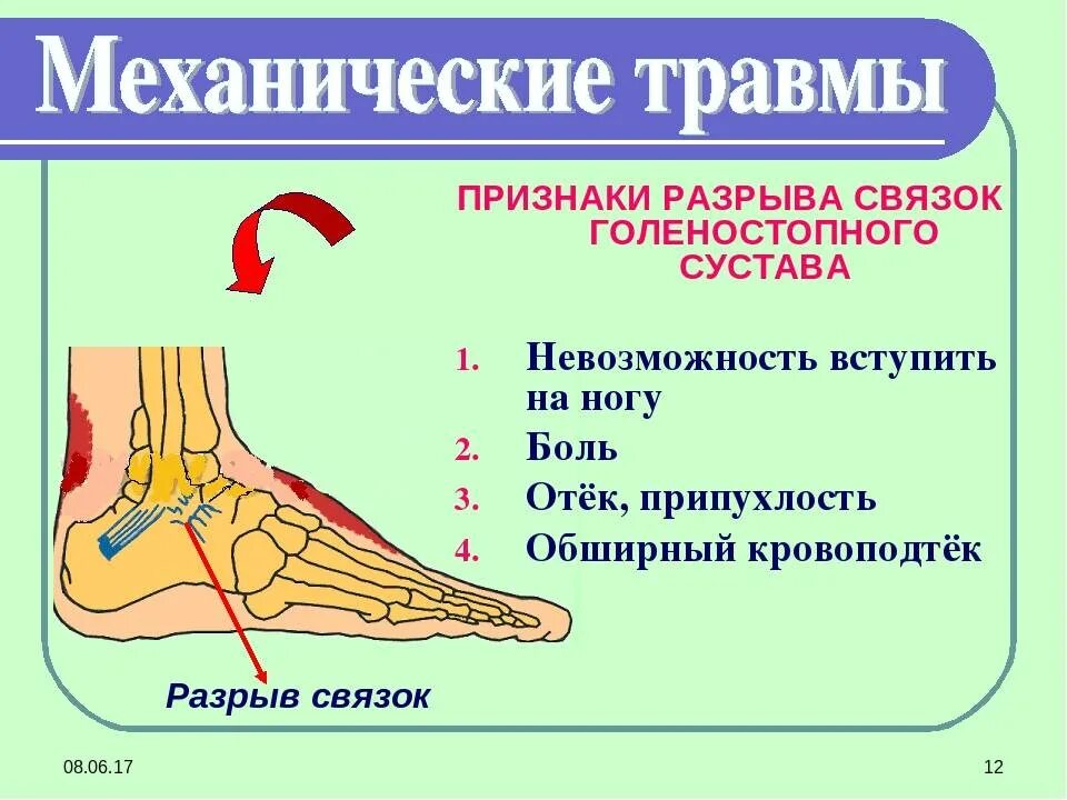 Травма голеностопа с повреждением связок. Травма капсульно-связочного аппарата голеностопного сустава. Повреждение связок голеностопного сустава 1 степени. Разрыв связок голеностопного сустава.