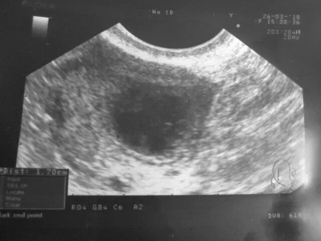 Плодное яйцо 3 мм. Плодное яйцо 14 мм желточный мешок 3 мм. плодное яйцо 9 мм желточный мешок 3,6 мм. плодное яйцо 7 мм желточный мешок 1.3 мм.