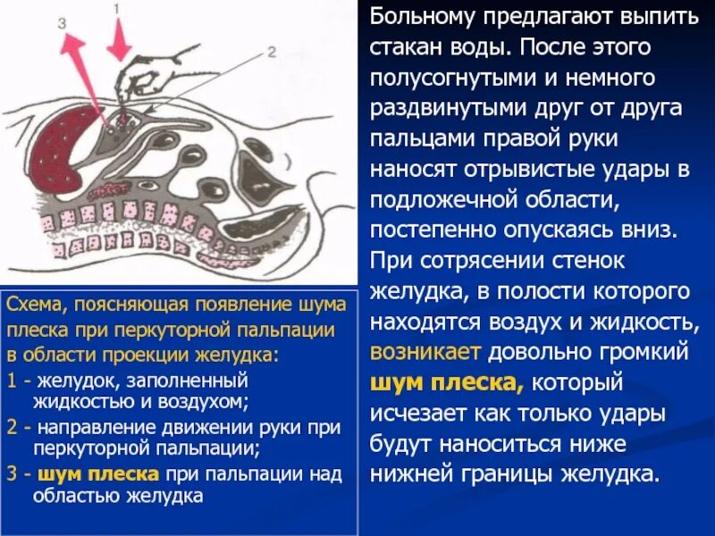 Эритематозная гастродуоденит. Пальпация пилорического отдела желудка. Опухоль в пилорическом отделе желудка. Шум плеска натощак. Плеск в желудке.