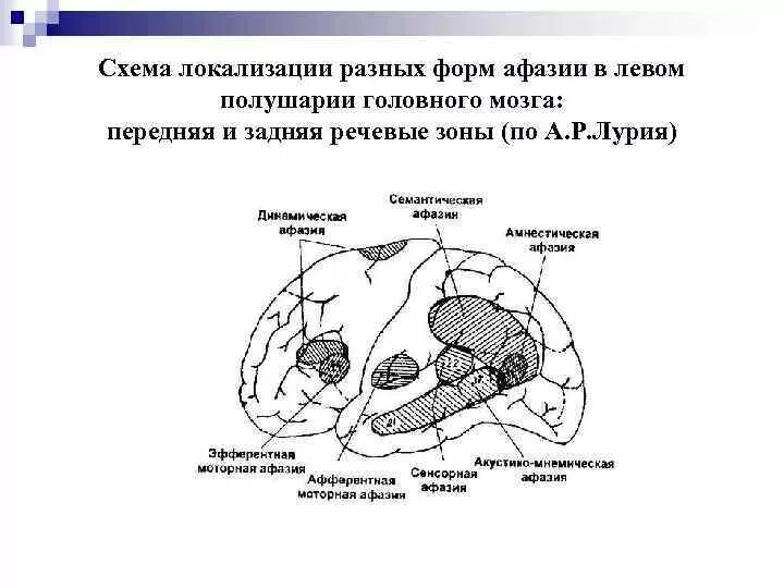 Теменные формы афазии. Классификация афазии лурия. формы афазий по а.р лурия. афазии схема мозга. классификация афазии по локализации поражения( по р.а. лурии).
