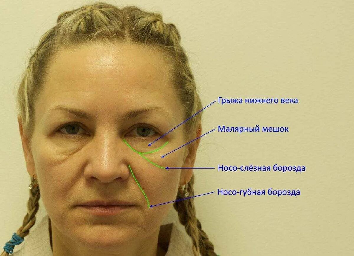 Отек под глазом как мешок лечение