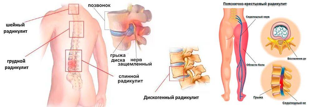 Симптомы поясничной радикулопатии. Симптомы радикулита поясничного отдела. Радикулит воспаление Корешков. Дискогенная пояснично-крестцовая радикулопатия l5-s1 неврология. Пояснично-крестцовый радикулит симптомы.