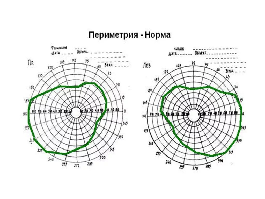 Исследование полей зрения периметрия компьютерная, статическая. Тотальная периметрия глаза норма. Поле зрения расшифровка. Периметрия поля зрения норма. Поле зрения расшифровка.