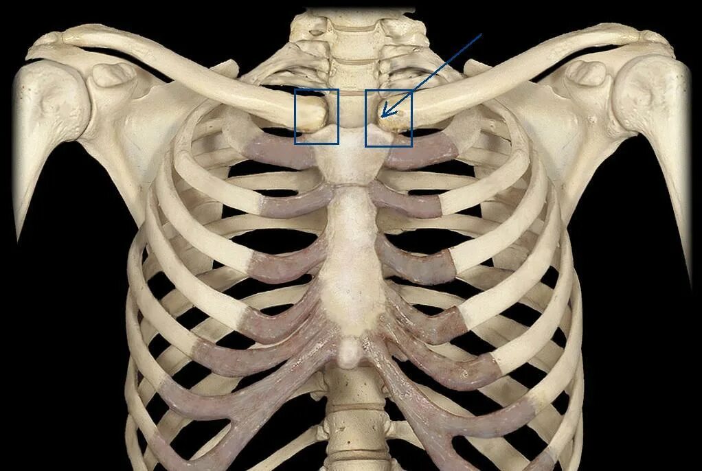 Трубчатая грудная кость. Артроз реберно-грудинного сочленения на рентгене. Артроз 1 реберно-грудинного сочленения рентген. Кт реберно грудинных сочленений. Артрит реберно-грудинного сочленения.