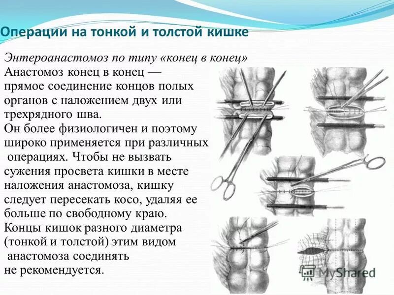 Наложение шва латынь. Операции на тонкой и толстой кишке. Резекция тонкой кишки конец в конец.