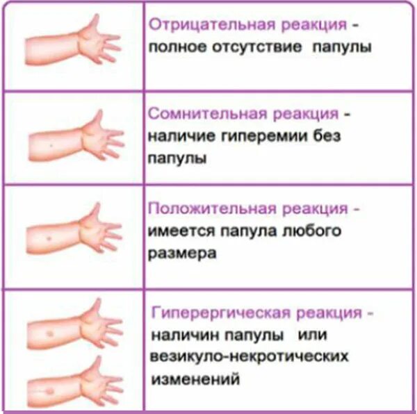 До какого возраста делают диаскинтест. Можно сделать манту при кашле ребенку. диаскинтест ребенка нормы и отклонения. положительный результат дст у ребенка.